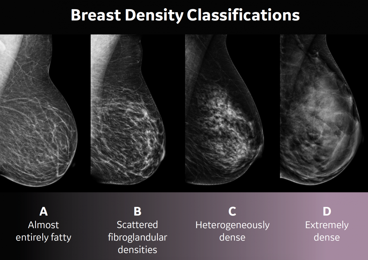Breast density classifications