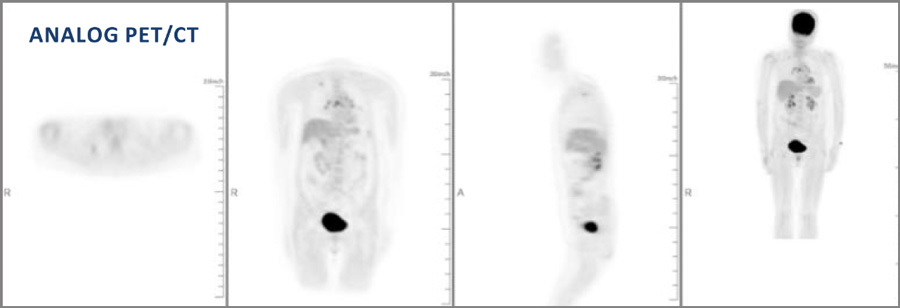 Analog PET/CT scan imaging