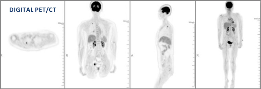 Digital PET/CT scan imaging