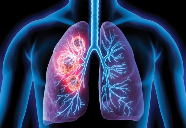 Ilustración de formas en pulmones humanos
